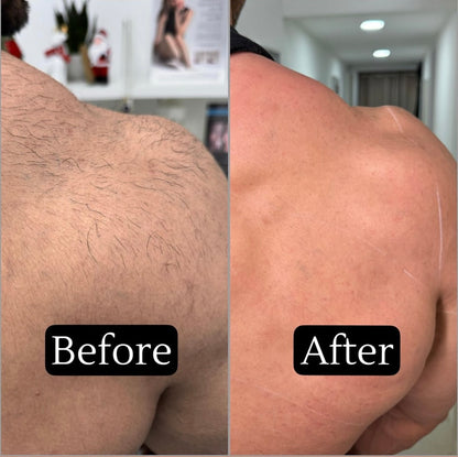 SkinTrim - Recortadora 2 en 1 para la Línea del Bikini y el Rostro